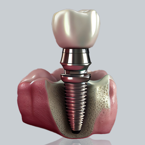 Dental implant in Madurai