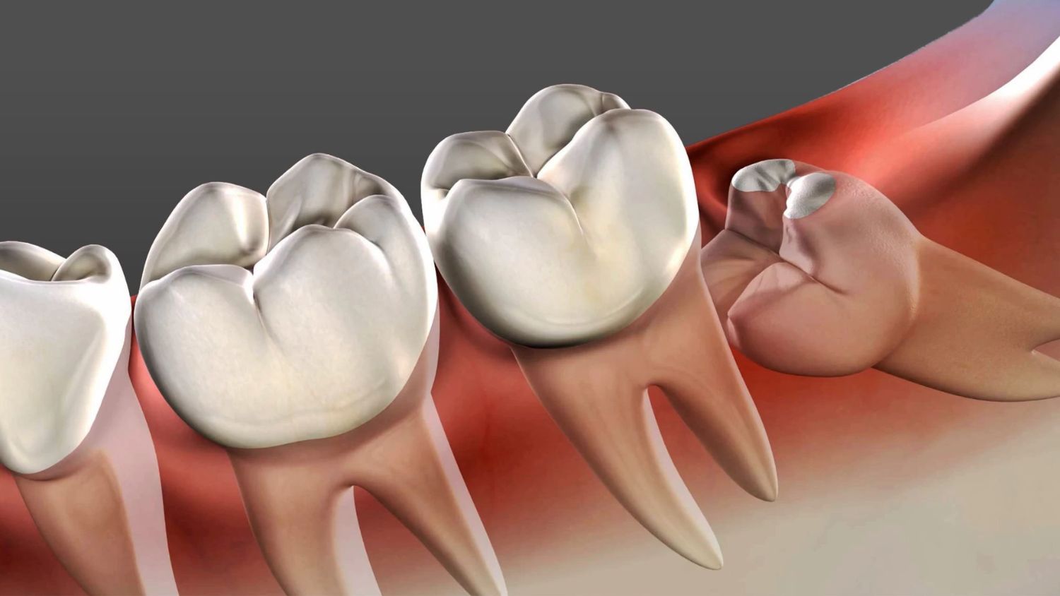 Wisdom Tooth Removal in Madurai